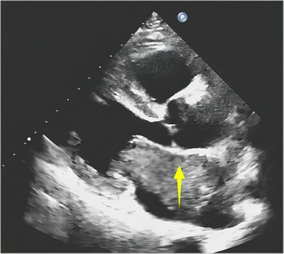 Case Report: Primary malignant mesothelioma of the left atrium easily misdiagnosed as myxoma